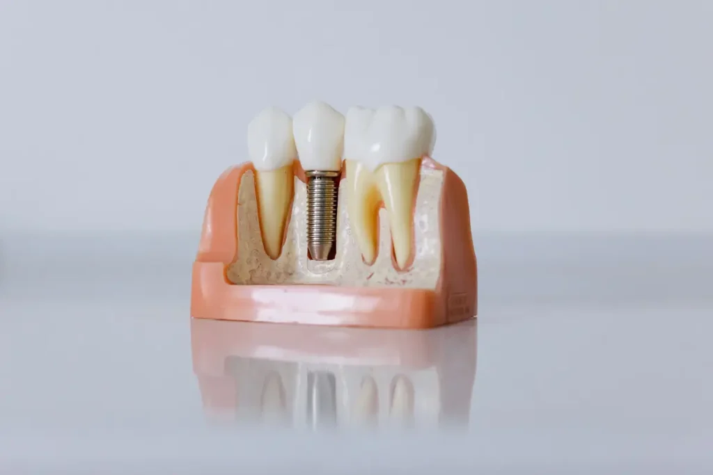 Implant dentaire : la solution durable pour remplacer une dent absente