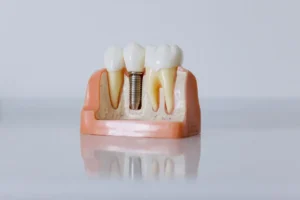 Implant dentaire : la solution durable pour remplacer une dent absente